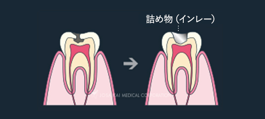 C2：象牙質に達した虫歯