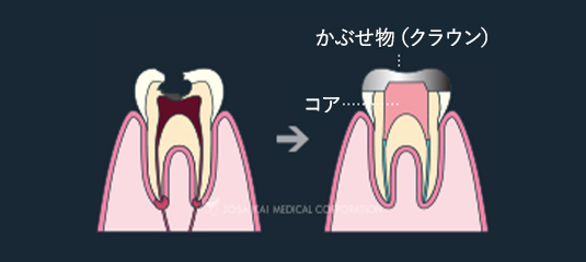 C3：歯髄（神経）に達した虫歯