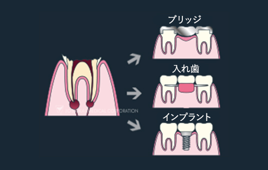 C4：歯質が失われた虫歯