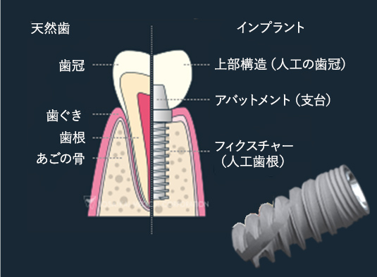 インプラントの基本的構造