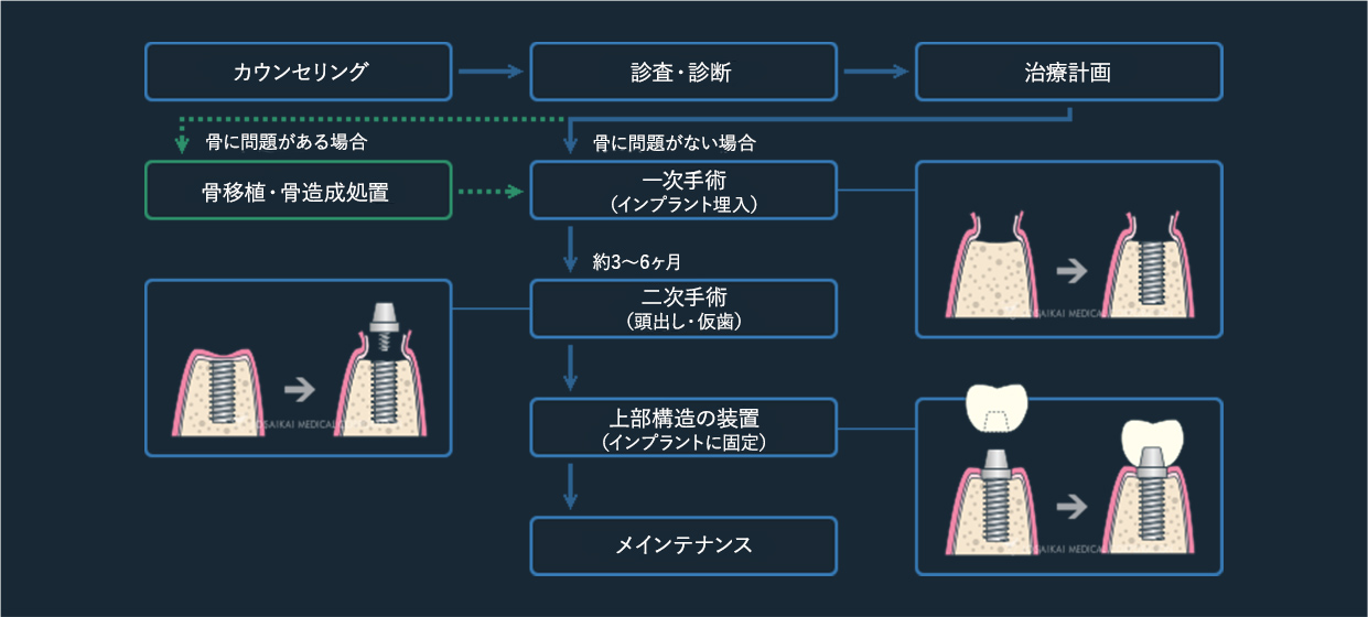 インプラント治療の流れ