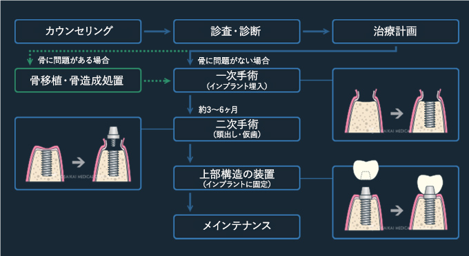 インプラント治療の流れ