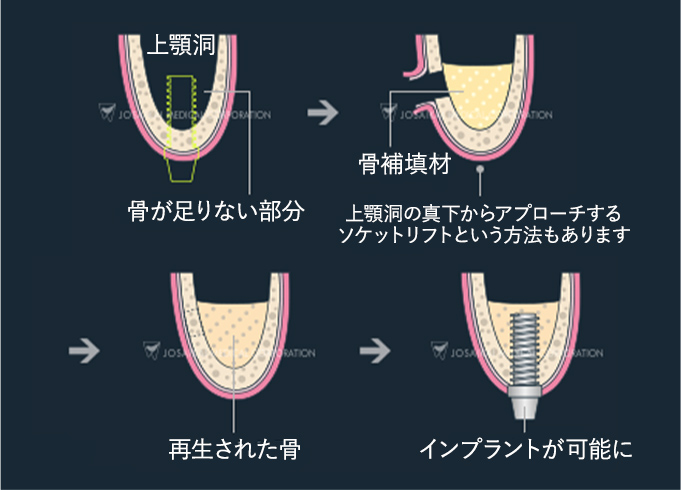 サイナスリフト