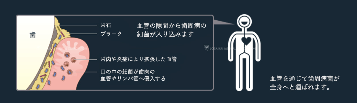 歯周病と全身との関わり