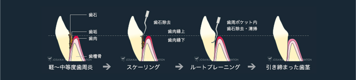 歯周病治療「歯周基本治療」