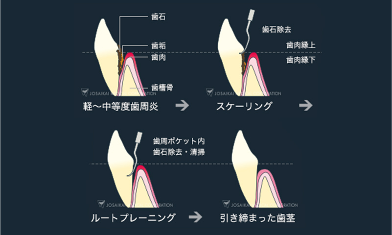 歯周病治療「歯周基本治療」