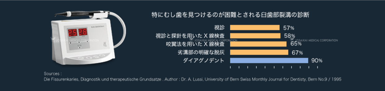 レーザー光を使用したむし歯の診断装置「ダイアグノデント」