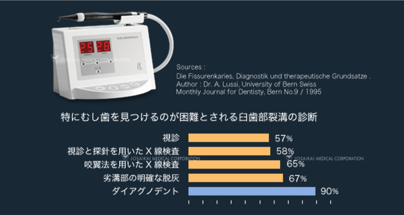 レーザー光を使用したむし歯の診断装置「ダイアグノデント」