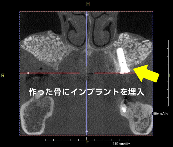 上顎洞挙上術（サイナスリフト・ソケットリフト）作った骨にインプラントを埋入