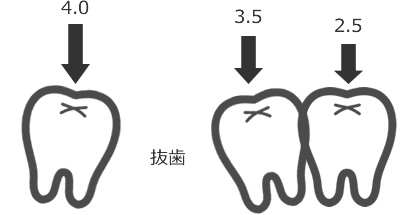 歯並びが歪んでいる場合、力の加わり方がバラバラ