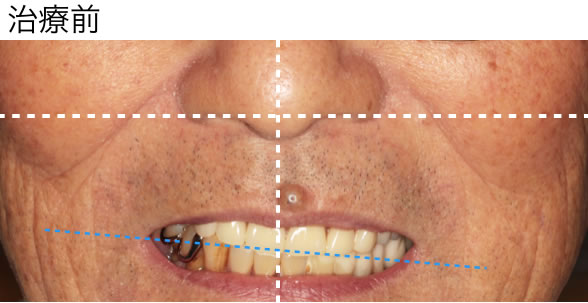 保険治療での入れ歯装着時