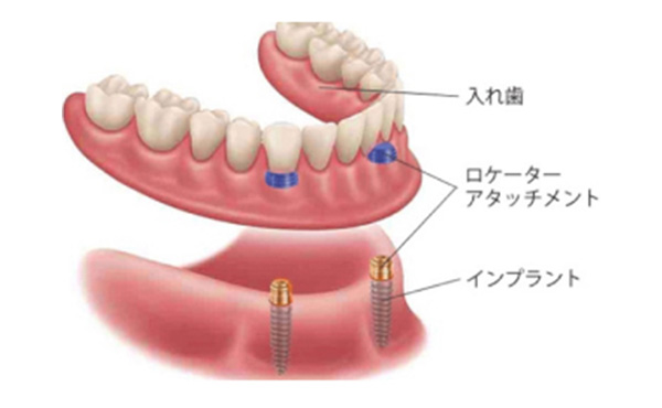 ロケーター義歯（インプラント対応）