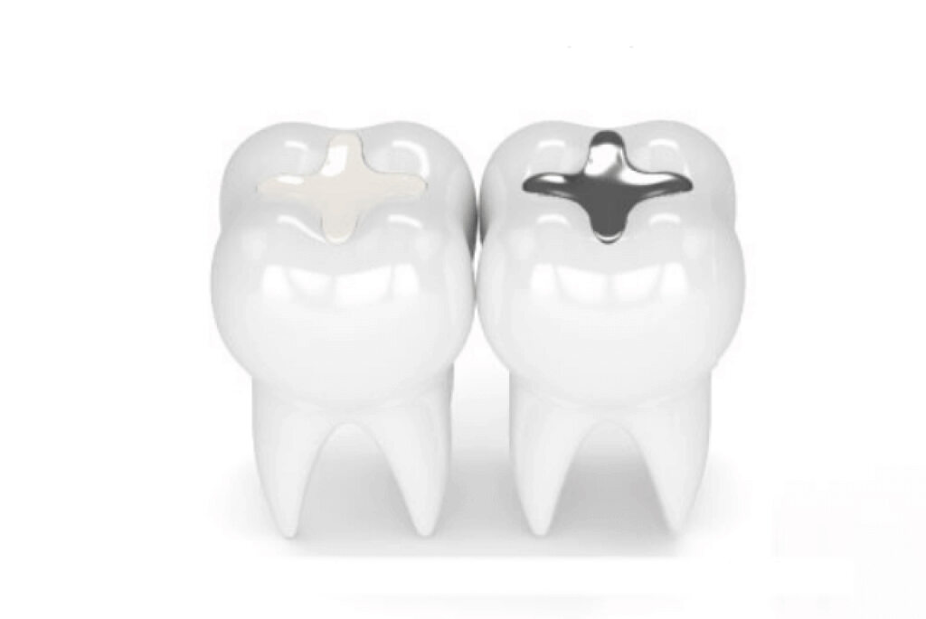 日本で銀歯が多い理由